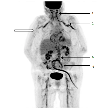 Figure 1 Fluorine-18 fluorodeoxyglucose (18F-FDG) positron emission tomography/computed tomography imaging. Black arrows show pathological FDG uptake in the external carotid (a), subclavian and axillary arteries (b), aorta (c) and iliac arteries (d) that contrast with normal vessel (white arrow)