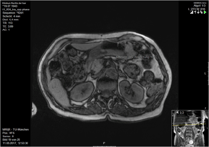 Figure 1 Abdominal MRI scan, axial plane, T1-weighted image